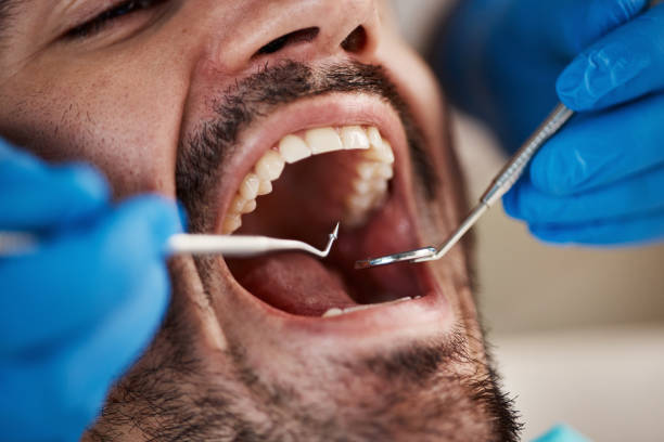 Best Knocked-Out Tooth (Avulsed Tooth) Treatment in Marriott Slaterville, UT